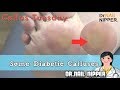 some diabetic callus #21 - Callus Tuesday