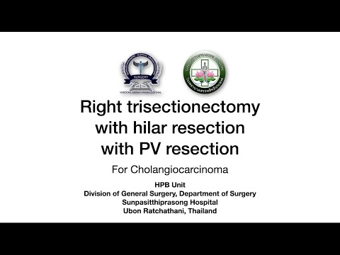 Right trisectionectomy with Hilar resection and portal vein resection for pCCA, an UNCUT video