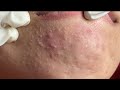 Acne treatment huong da nang600  2024  whiteheads