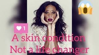 Winnie Harlow Model( Fashion with Passion)