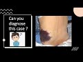 BLUE SKIN | Can you diagnose this case ? | Case 3