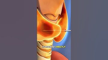 Radiofrequency Ablation Surgery to Treat Thyroid Nodules (3D Animation)Hashtags:#radiofrequencyablat