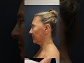 Deep Place / Uplift #faceliftsurgery  by Dr. Soler Baillo #facerejuvenation in Coral Gables, Miami