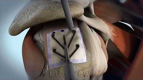 Regeneten Bioinductive Implant