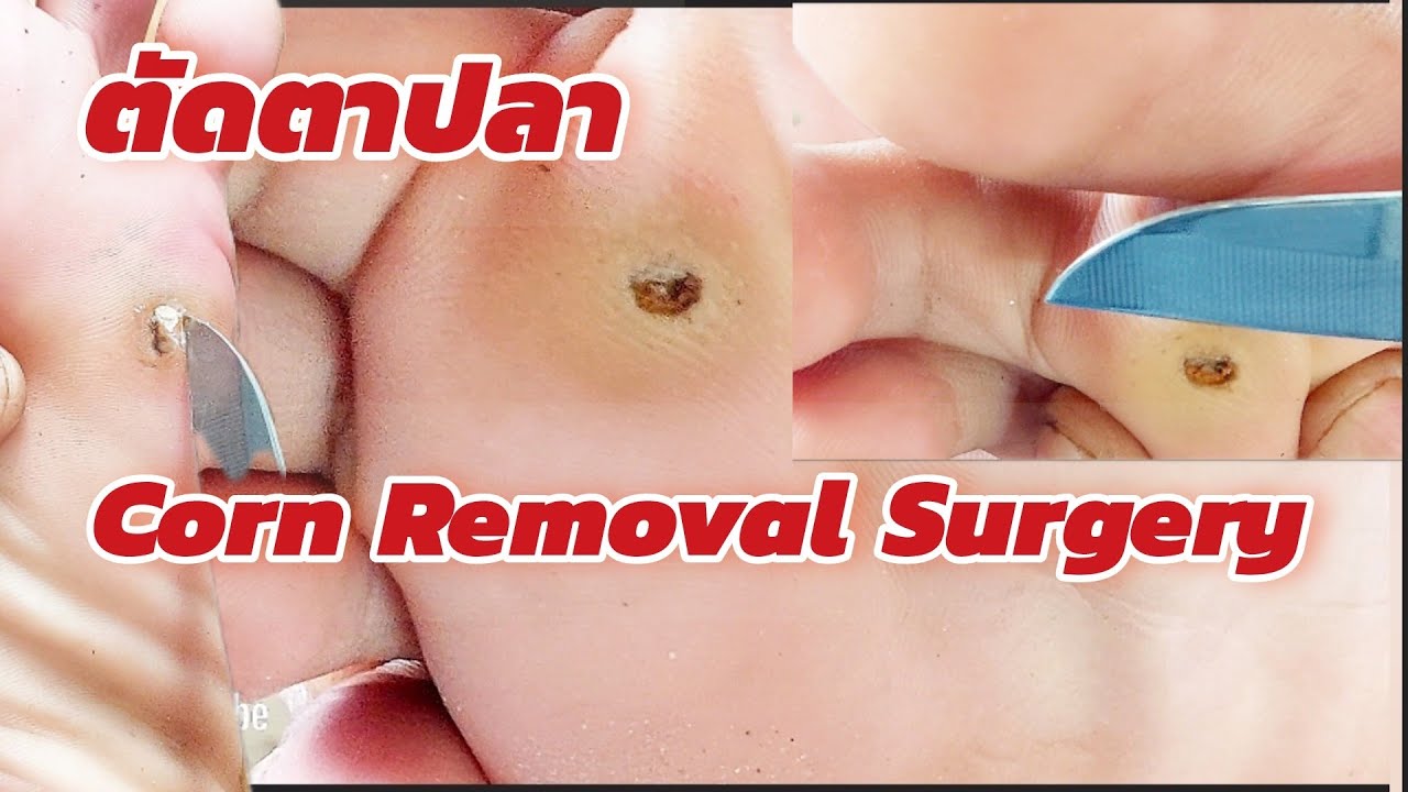 Corn Removal Surgery วิธีตัดตาปลา ตอนที่ 3 YouTube