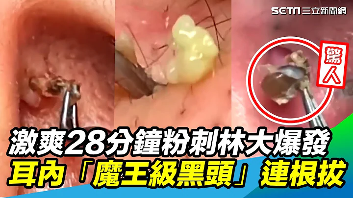 28分钟激爽片！粉刺林、巨痘大爆发 耳内“魔王级黑头”连根拔起｜@setn - 天天要闻