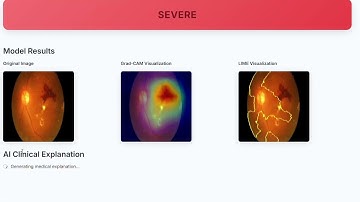 Detection of Diabetic Retinopathy Using AI