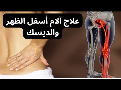 علاج آلام أسفل الظهر والديسك