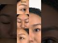 Before & After QCW #beautyclinic #beautyproducts #doubleeyelidsurgery #beauty #beautydoctor #skin