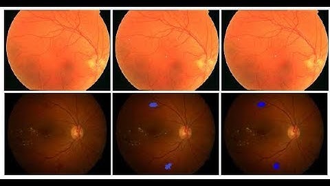 Automatic Detection of Retinal Lesions for Screening of Diabetic Retinopathy | Matlab Projects