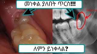 የመንጋጋን ጥርስ ማስነቀል!!!/ (Wisdom Teeth Removal)