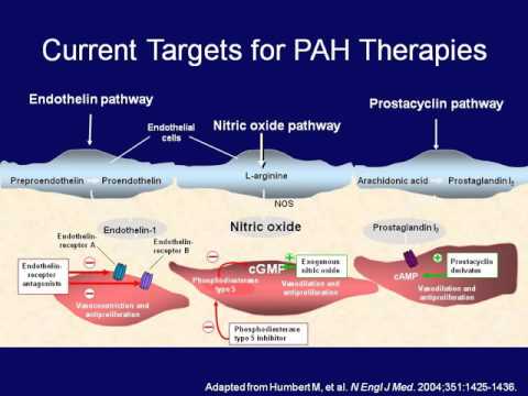 Pulmonary Hypertension as a Complication of Scleroderma: A 