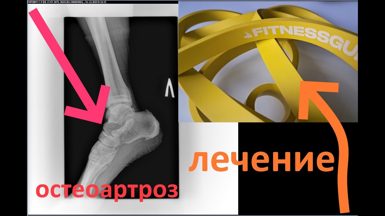 🚑Остеоартроз голеностопного сустава - лечение.🚑 - YouTube