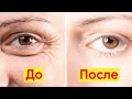 КАК УБРАТЬ ОТЕКИ И ТЕМНЫЕ КРУГИ ПОД ГЛАЗАМИ НАВСЕГДА