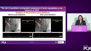 Cutting-edge technologies: clinical updates on TES, BRS, TAVR and LAA closure - EuroPCR 2023