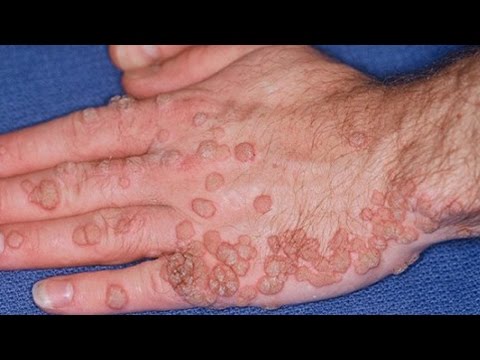 dating a woman with genital warts Chapter 7: dating terms match to the a sexually transmitted infection that can damage a woman's reproductive organs genital warts. dating a woman with genital warts Chapter 7: dating terms match to the a sexually transmitted infection that can damage a woman's reproductive organs genital warts.