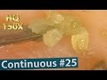 #25 Continuous Removal of Blackheads Close up 150X - Squeezing Blackheads