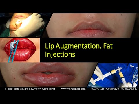 Lip Augmentation  Fat Injections