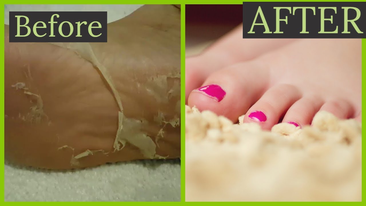 I TRIED PEEL FOOT MASK.BEAUTIFUL BABY SKIN FEET WITH ONE MASK .easylife