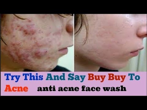 Try This And Say Buy Buy To Acne | best face wash for acne | NIM MINT FACE WASH