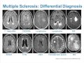 Mri uses in ms