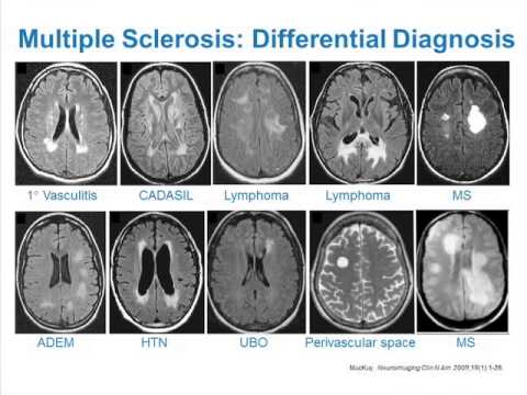 ms mri lesions sclerosis multiple diagnosis csf