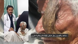 شاهد بالفيديو رجل عاش 160عام وطلع له قرون في رائسه