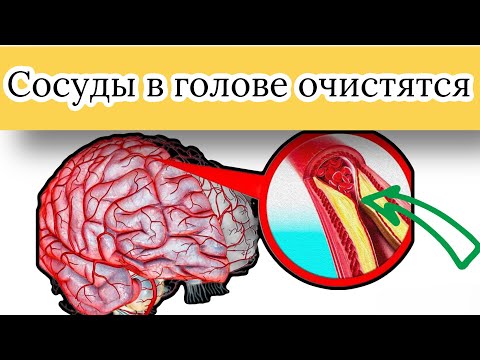 Сосуды головы чистятся. Чистка сосудов головы. Разжижение крови, избавление от тромбов в сосудах