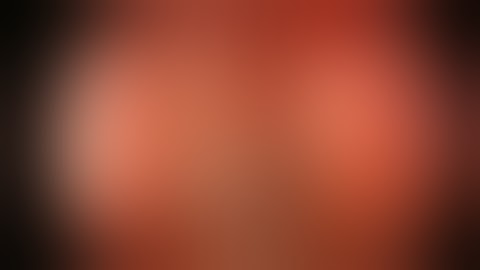 Comparison of results- Routine FESS & Draf3 after 1 yr