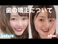矯正についてお話します