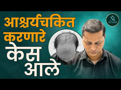 Grade 6 Baldness Hair Transplant - STUNNING RESULTS 😍 | Vashi/Navi Mumbai | New Roots