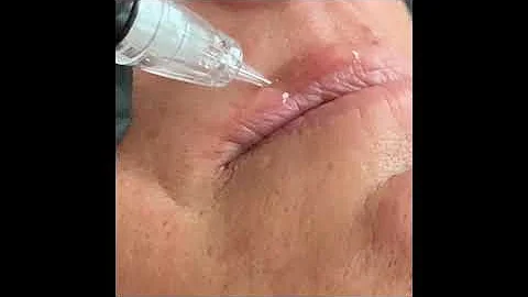 Micro needling lips2