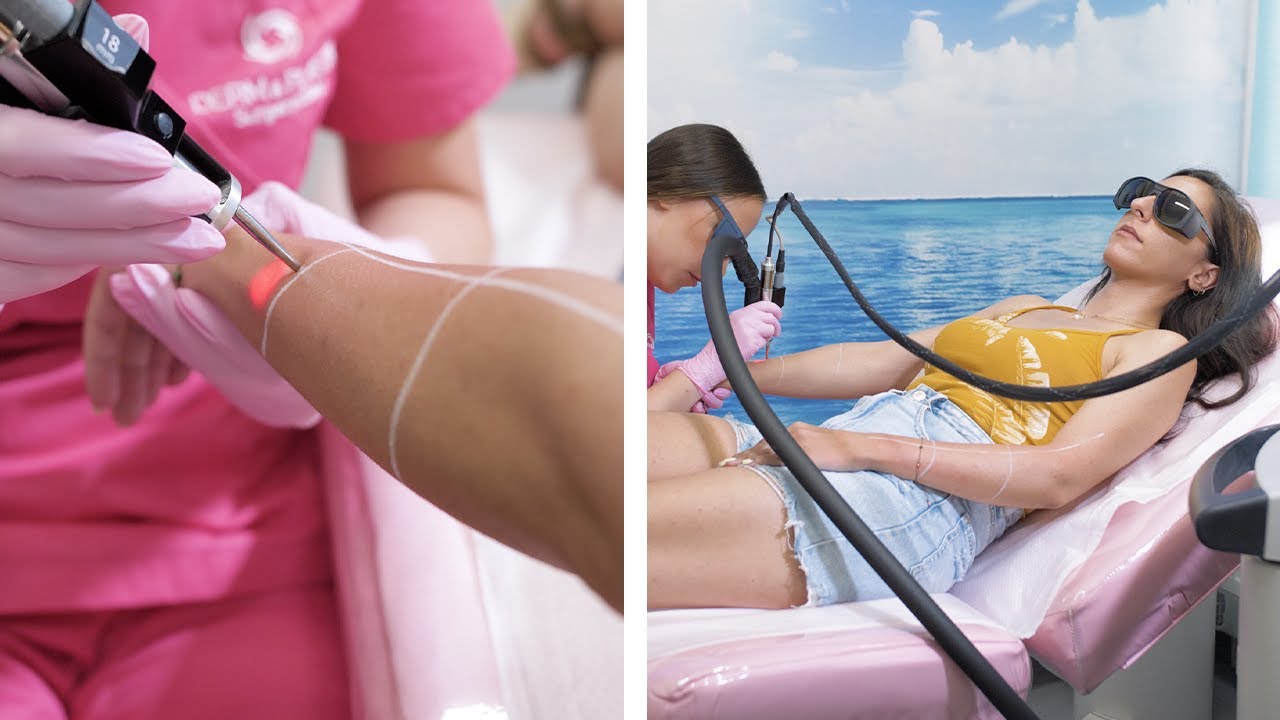 Laser Αποτρίχωση με Αλεξανδρίτη στα Χέρια 