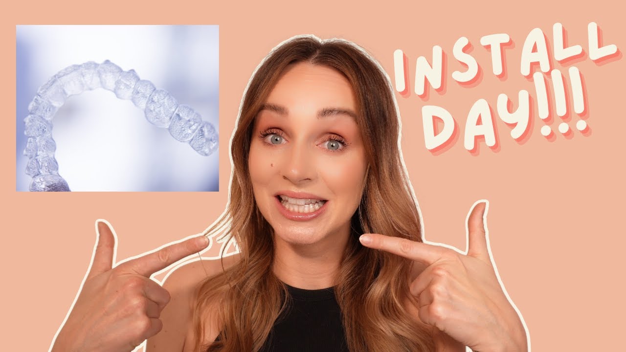 Invisalign Journey | Part 2 - Install Day - YouTube