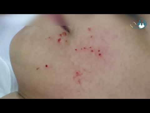 Vídeo: Como reconhecer o molusco (molusco contagioso): 11 etapas