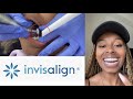 The end of my Invisalign Journey!! (in the UK)