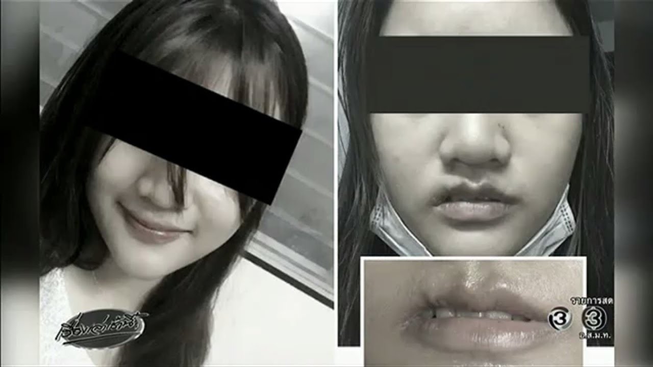 สาววัย 22 ทำศัลยกรรมปากกระจับ พลาดปากแหว่งเบี้ยวเสียโฉม แพทย์ปัดรับผิดชอบ