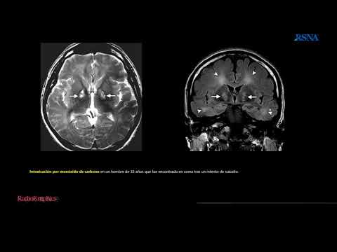 Vídeo: Experiencia Diagnóstica Y Clínica De Pacientes Con Neurodegeneración Asociada A Pantotenato Quinasa