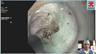 Gastric Per Oral Endoscopic Myotomy (G-POEM) for refractory gastroparesis