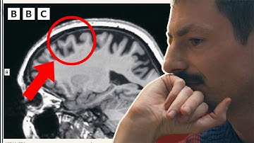 Son sees how Alzheimer