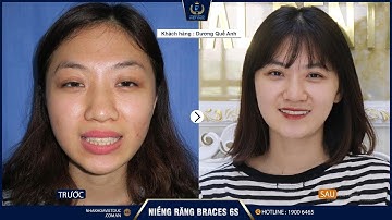 "Lột xác" ngoạn mục sau khi niềng răng - Nha khoa Quốc tế Việt Đức