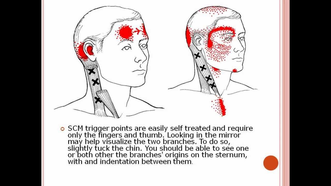 Head, Eye and More Pain from Sternocleidomastoid Muscle Trigger Points