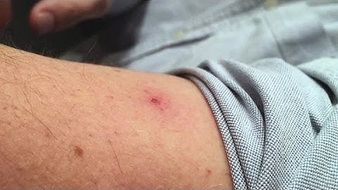 Simple step to rid your backyard of mosquitoes