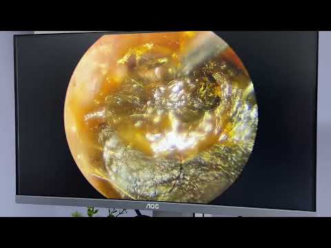 Endoscopic removal of giant impacted earwax / Endoskopik kulak kiri - buşonu temizliği