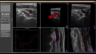 Automatic Carotid Detection and Segmentation from Freehand Ultrasound
