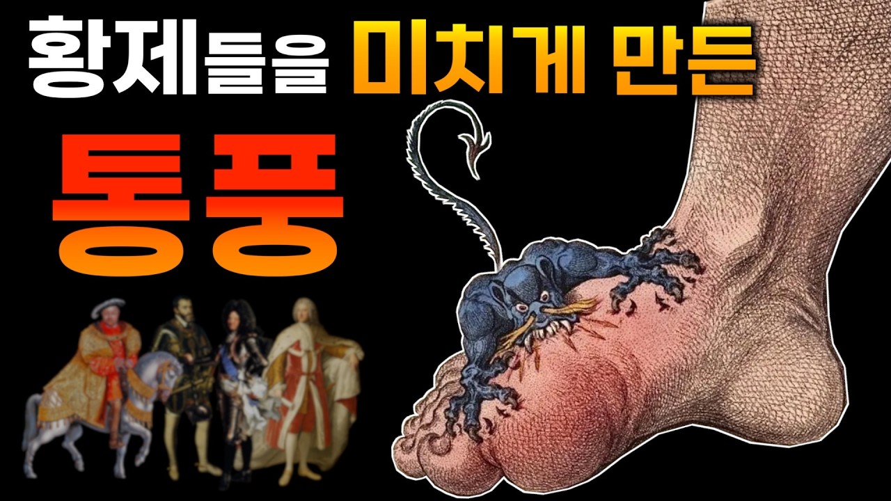 통풍에 걸리고 싶어 안달 났던 권력자들 | 부자만 걸리는 병 | 통풍의 역사