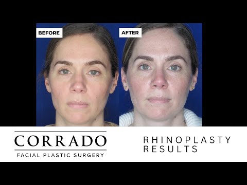Video thumbnail: Emotional Rhinoplasty Reveal - Nose Job Surgery Reveal | Dr. Anthony Corrado · Dr. Anthony Corrado