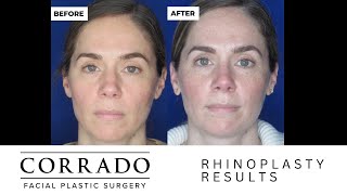 Emotional Rhinoplasty Reveal - Nose Job Surgery Reveal | Dr. Anthony Corrado