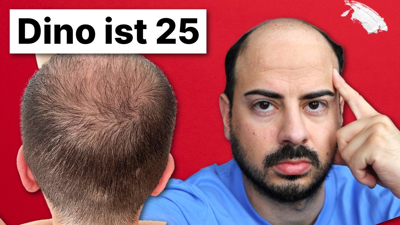 Haartransplantation trotz Glatze (Norwood 7)...