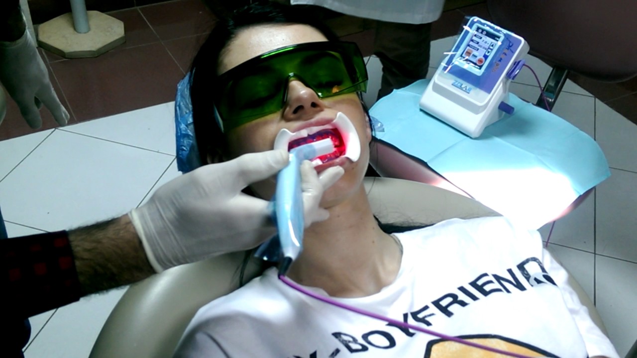 Using diode laser for bleaching Sheraton Dental Clinic YouTube